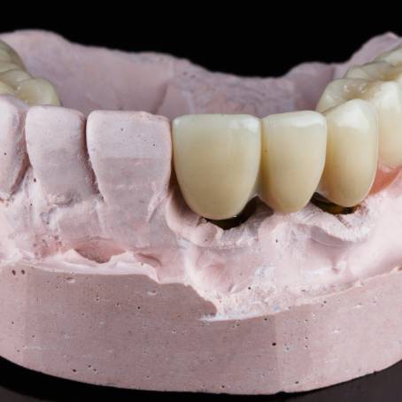 The Future of Dental Prosthetics Modeling and Costs